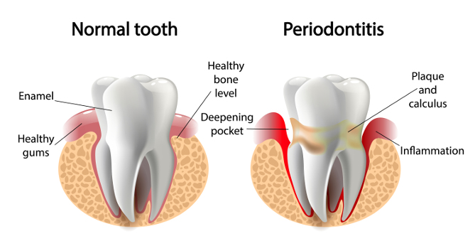 parodontitis und herz kreislauf erkrankungen full