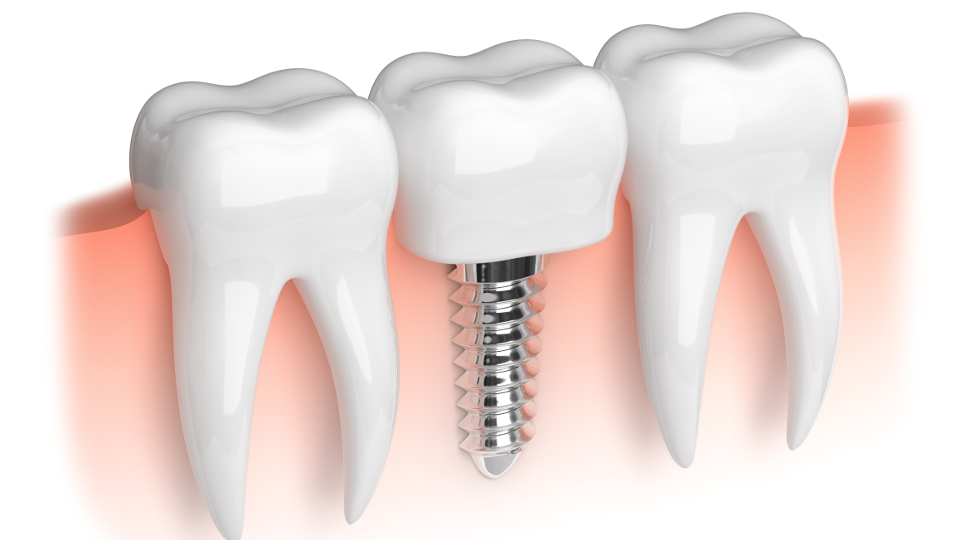 implantate was sie wissen muessen full